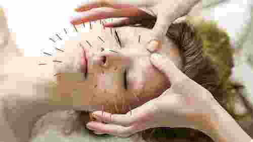  Acupuncture Treatment