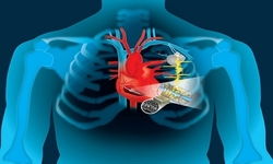 Cardiac Devices