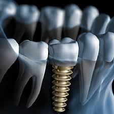 Dental Implants, Risks and Complications