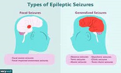 Epilepsy and Types of Seizures