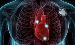 Implantable cardioverter-defibrillator (icd)