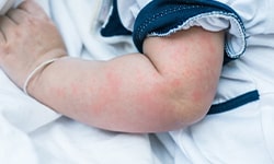 Pediatric Allergy and Infections