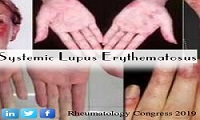 Systemic Lupus Erythematosus