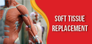 Soft Tissue Replacement
