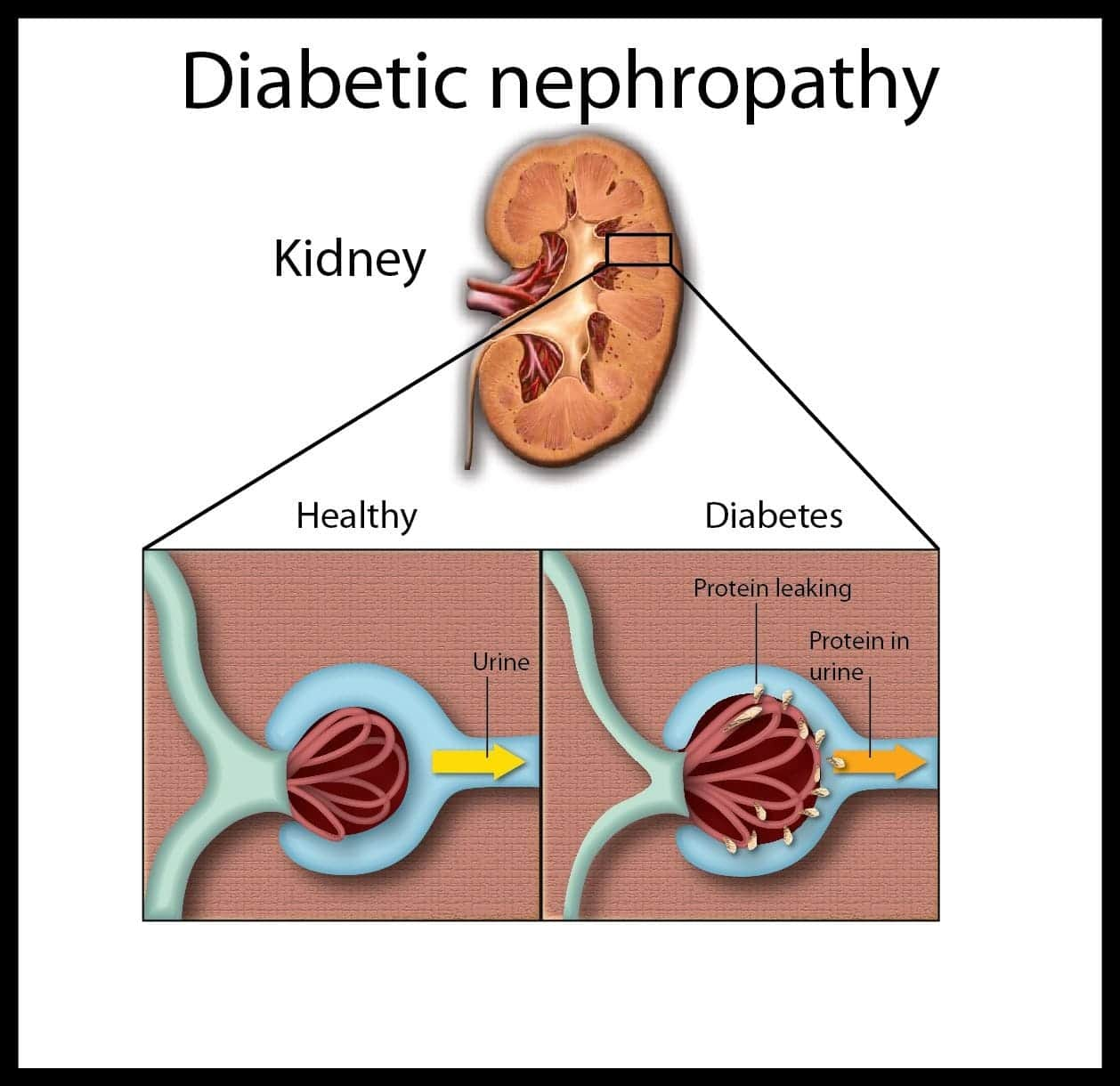 What Is Type 2 Diabetes Mellitus With Diabetic Nephropathy