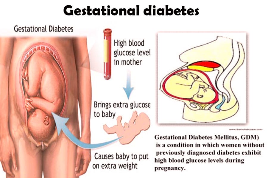 Gestational Diabetes Baby Weight Chart